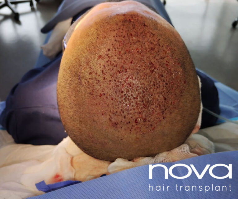 Benefits of FUE hair transplant
