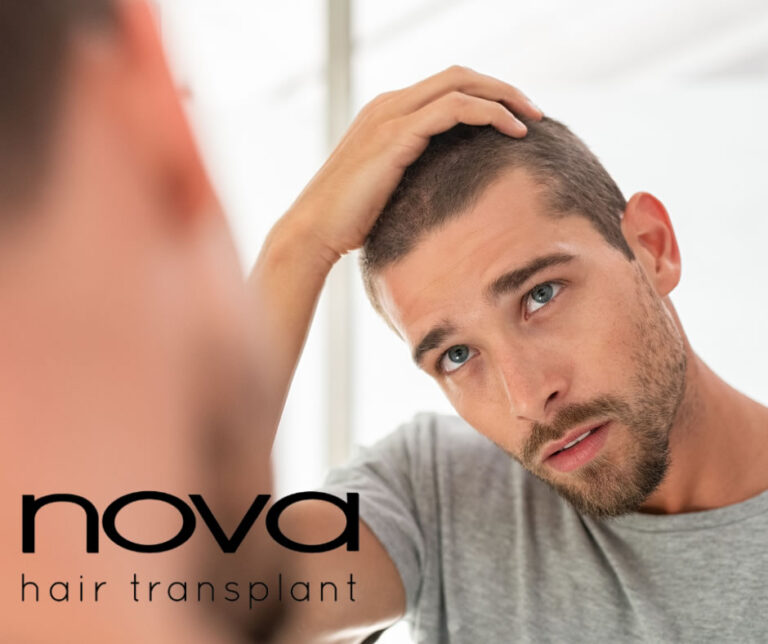 After hair transplantation