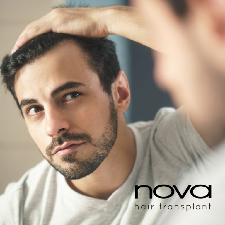 Alopecia en hombres