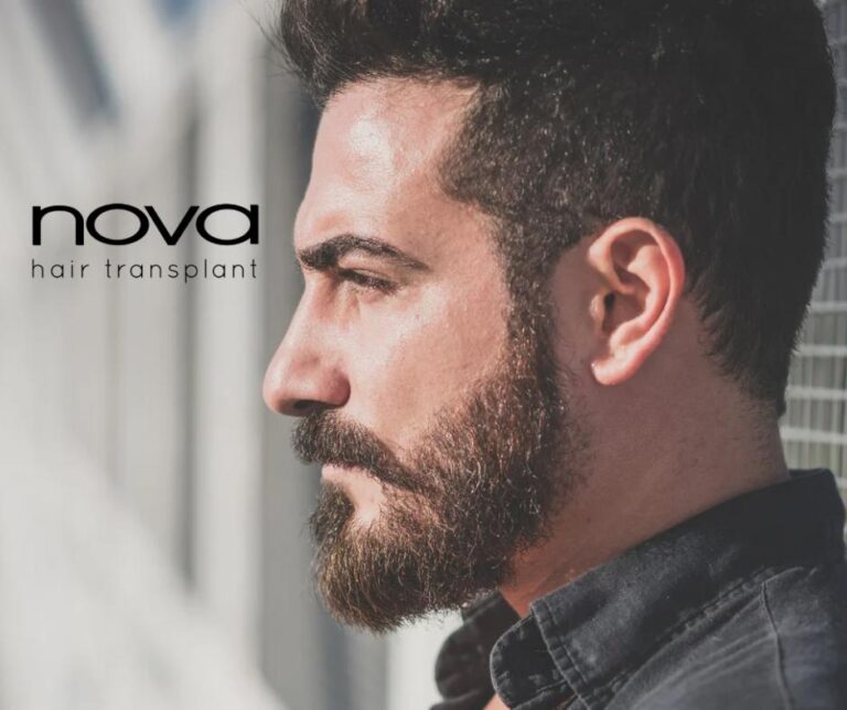 ¿En qué consiste el trasplante capilar en barba?