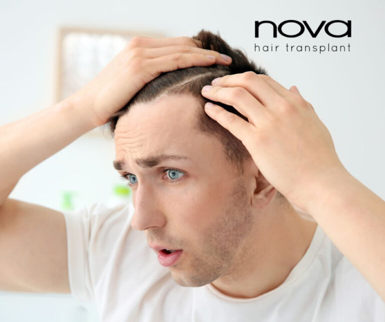 Alopecia temprana: ¿por qué ocurre y qué puedes hacer desde ahora?