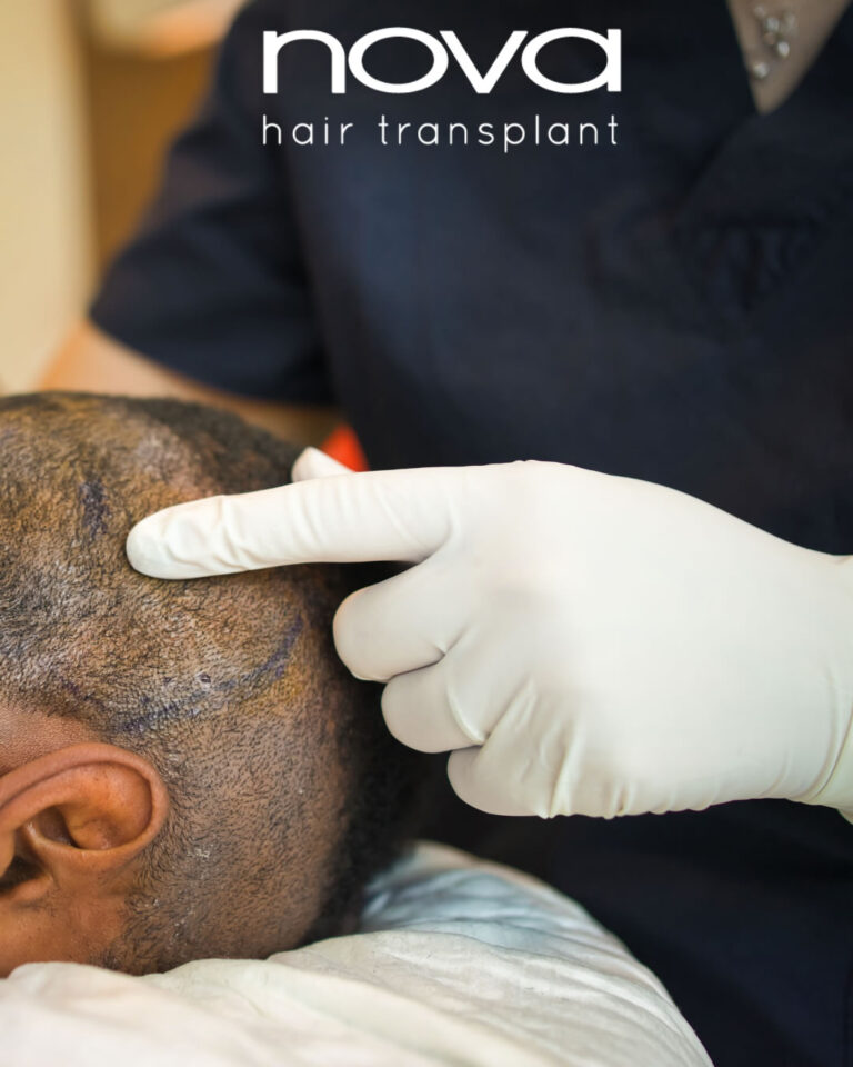 Trasplante capilar FUE: la solución definitiva para la pérdida de cabello
